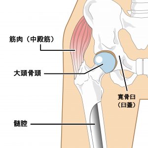 人工関節の構造