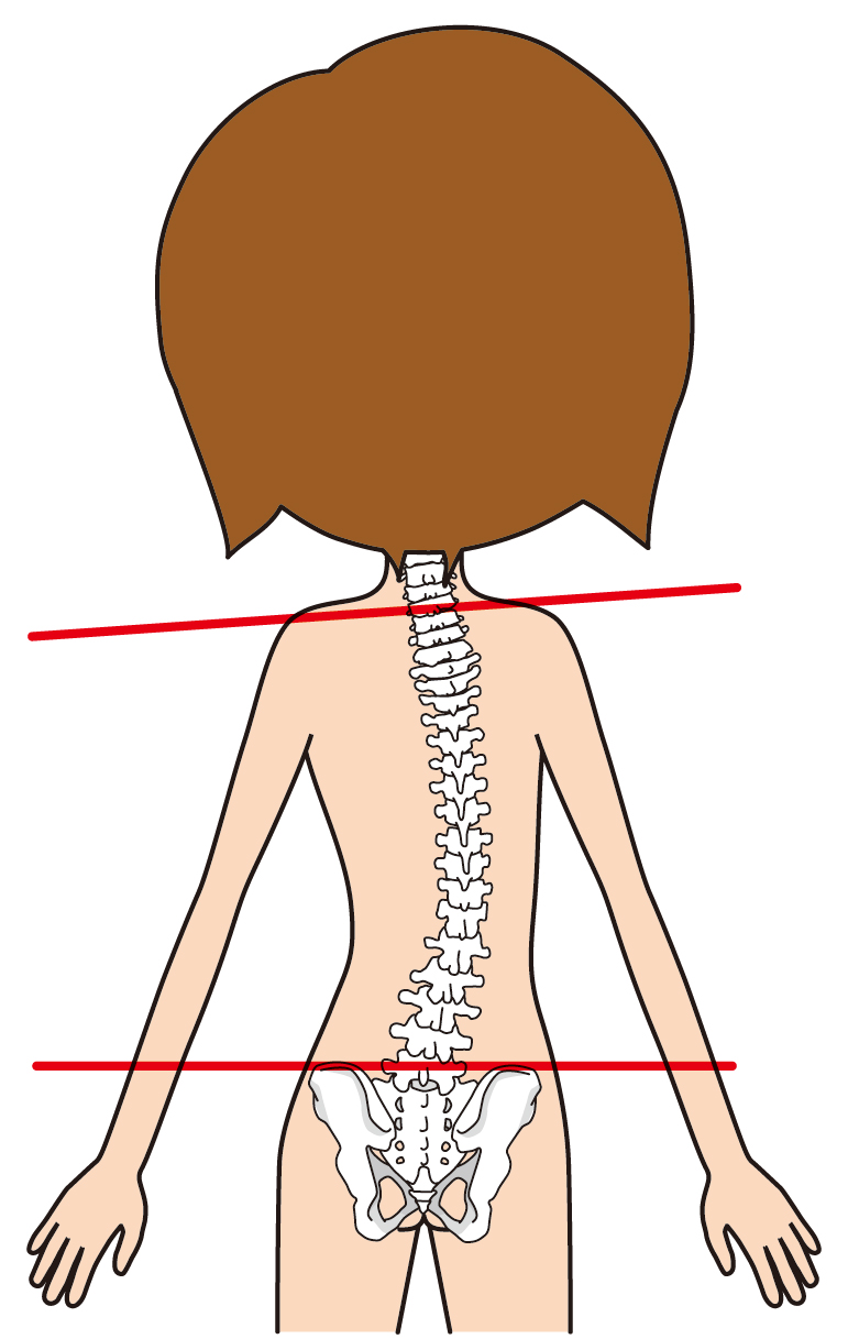 重要】側弯症 | 沖縄県那覇市首里汀良町 スマイル鍼灸整骨院整体マッサージ院頭痛｜頭痛・肩こり・腰痛・めまい